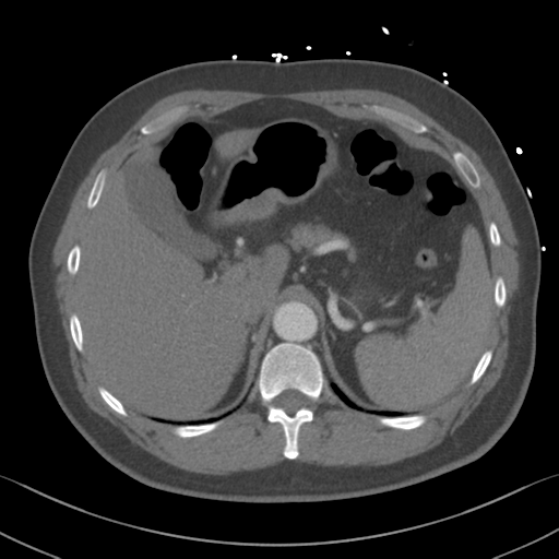 File:Aortic dissection (Radiopaedia 50763-56234 A 76).png