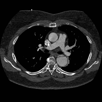 File:Aortic dissection (Radiopaedia 57969-64959 A 138).jpg