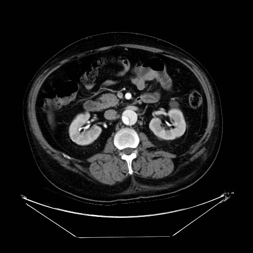 Aortic dissection (Radiopaedia 62562-71000 A 63).jpg
