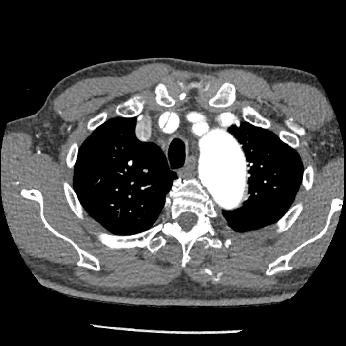 Aortic dissection - DeBakey Type I-Stanford A (Radiopaedia 79863-93115 A 6).jpg