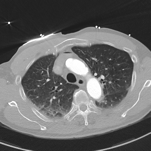 File:Aortic dissection - DeBakey type II (Radiopaedia 64302-73082 Axial lung window 18).png