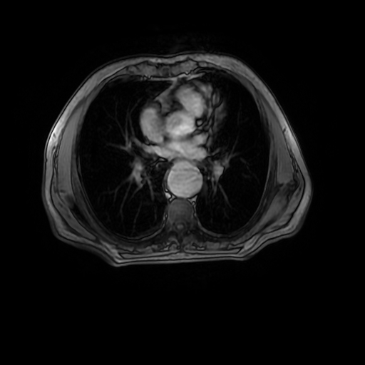 Aortic dissection - Stanford A - DeBakey I (Radiopaedia 23469-23551 Axial MRA 19).jpg