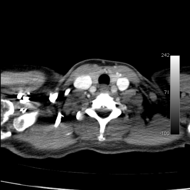 Aortic dissection - Stanford type A (Radiopaedia 29247-29659 A 3).jpg