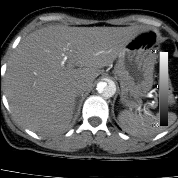 Aortic dissection - Stanford type A (Radiopaedia 29247-29659 A 72).jpg