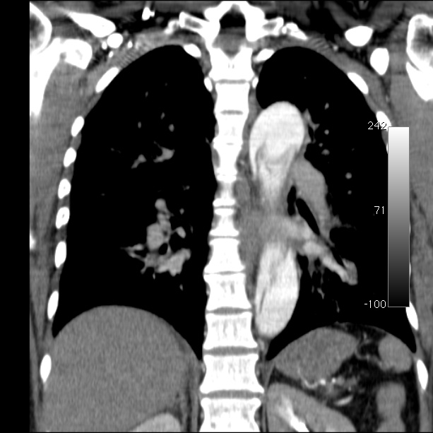 Aortic dissection - Stanford type A (Radiopaedia 29247-29659 B 41).jpg