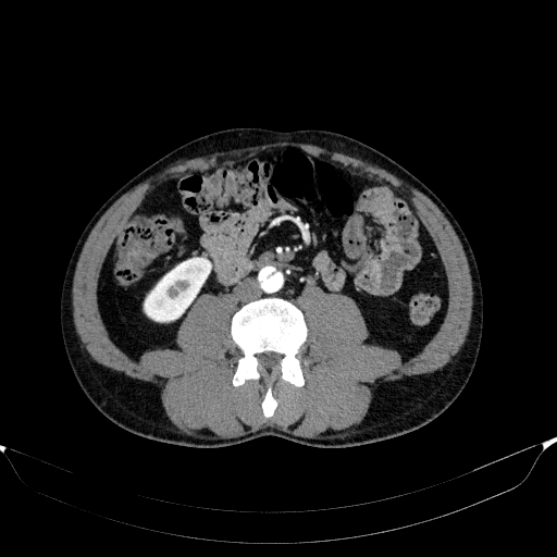 Aortic dissection - Stanford type A (Radiopaedia 83418-98500 A 85).jpg