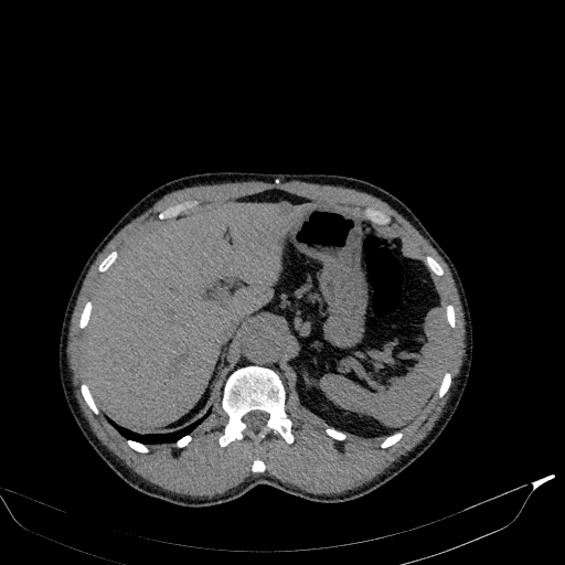 Aortic dissection - Stanford type A (Radiopaedia 83418-98500 Axial non-contrast 44).jpg