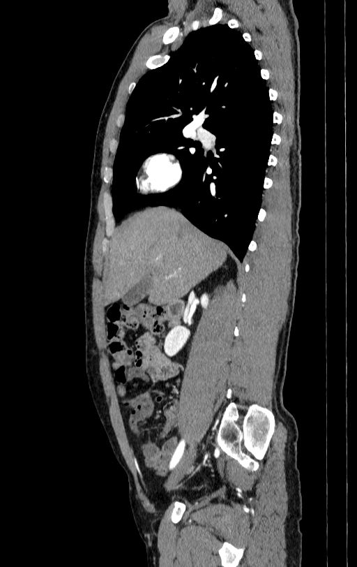 Aortic dissection - Stanford type A (Radiopaedia 83418-98500 B 5).jpg