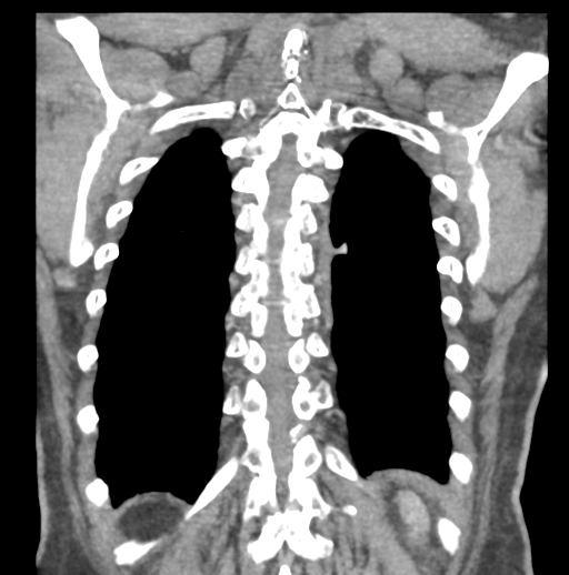 File:Aortic dissection - Stanford type B (Radiopaedia 50171-55512 B 71).png
