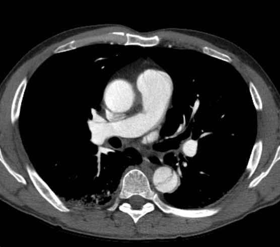 Aortic dissection - Stanford type B (Radiopaedia 73648-84437 A 49).jpg