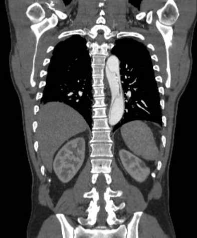 File:Aortic dissection - Stanford type B (Radiopaedia 73648-84437 B 86).jpg