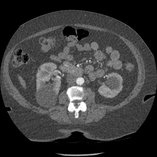 Aortic dissection - Stanford type B (Radiopaedia 88281-104910 A 120).jpg