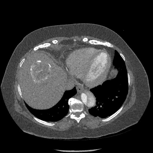 Aortic dissection - Stanford type B (Radiopaedia 88281-104910 A 72).jpg
