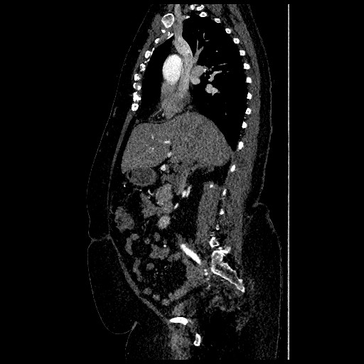 File:Aortic dissection - Stanford type B (Radiopaedia 88281-104910 C 29).jpg