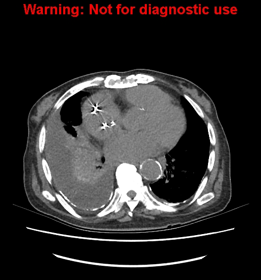 Aortic graft infection (Radiopaedia 44979-48907 Axial non-contrast 8).jpg