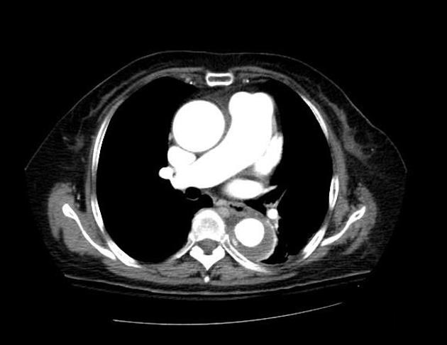 File:Aortic intramural hematoma (Radiopaedia 11198-11562 Axial 4).jpg