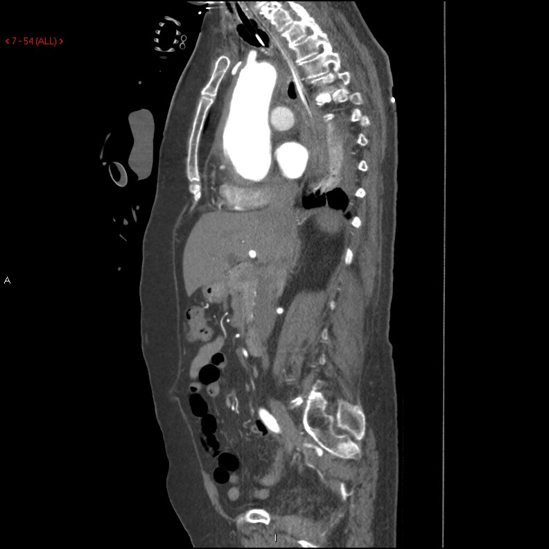 Aortic intramural hematoma (Radiopaedia 27746-28001 C 23).jpg