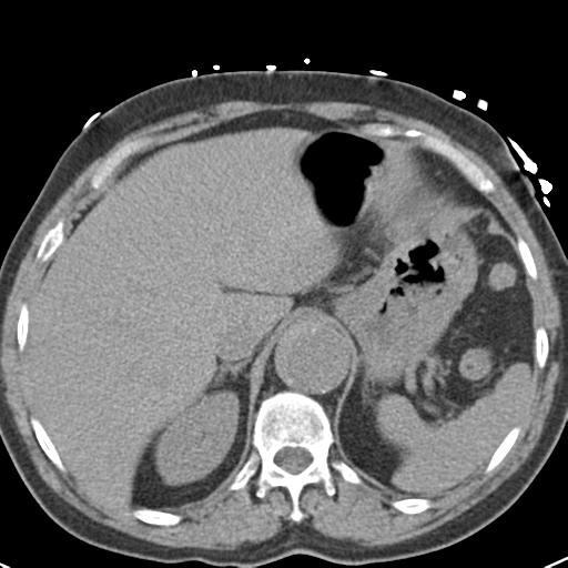 Aortic intramural hematoma (Radiopaedia 31139-31838 Axial non-contrast 49).jpg