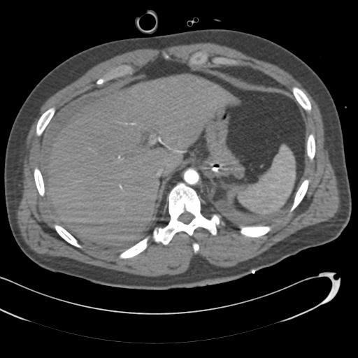 Aortic transection, diaphragmatic rupture and hemoperitoneum in a complex multitrauma patient (Radiopaedia 31701-32622 A 79).jpg