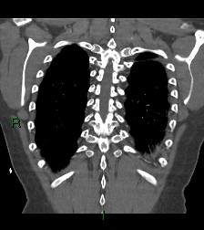File:Aortic valve endocarditis (Radiopaedia 87209-103485 D 13).jpg