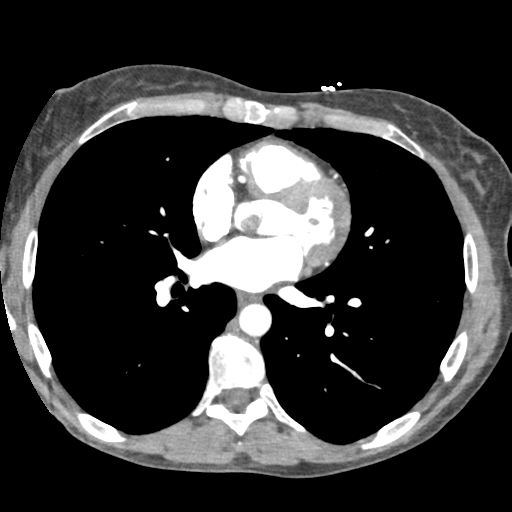 File:Aortic valve non-coronary cusp thrombus (Radiopaedia 55661-62189 A 21).png