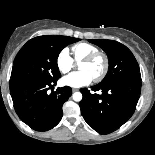 File:Aortic valve non-coronary cusp thrombus (Radiopaedia 55661-62189 A 31).png