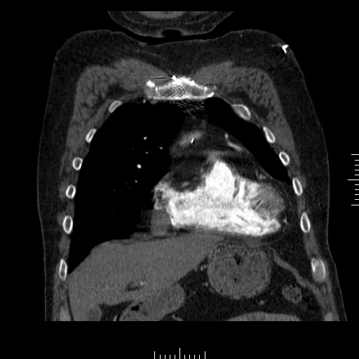 File:Aorto-coronary bypass graft aneurysms (Radiopaedia 40562-43157 B 10).png