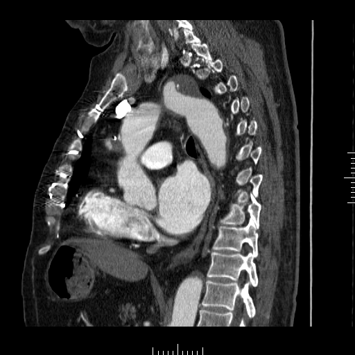 File:Aorto-coronary bypass graft aneurysms (Radiopaedia 40562-43157 C 20).png