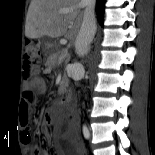 Aorto-left renal vein fistula (Radiopaedia 45534-49628 C 27).jpg
