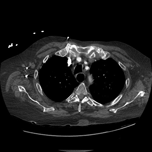 Aortoesophageal fistula with endovascular repair (Radiopaedia 73781-84592 Axial C+ CTPA 23).jpg