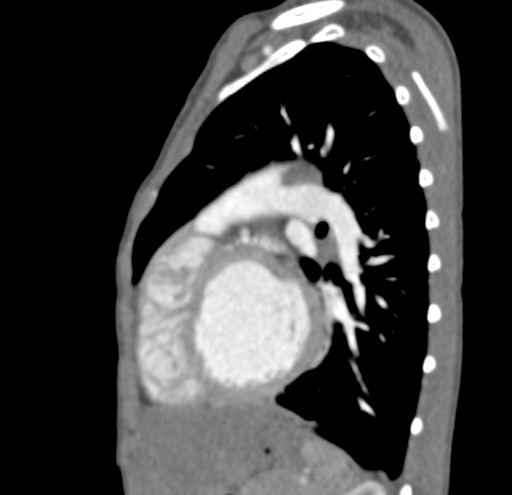 File:Aortopulmonary window, interrupted aortic arch and large PDA giving the descending aorta (Radiopaedia 35573-37074 C 35).jpg