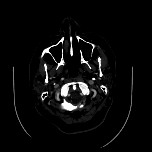 Aplasia of the internal carotid artery (Radiopaedia 61082-68960 A 6).jpg