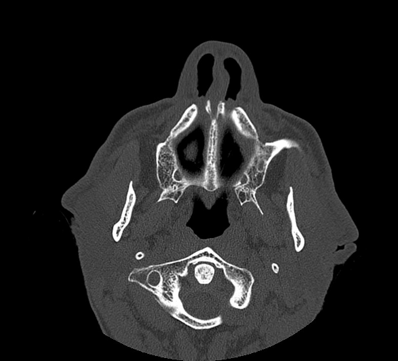 Aplastic maxillary sinuses (Radiopaedia 60030-67561 Axial non-contrast 16).jpg