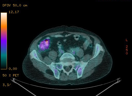 Appendiceal adenocarcinoma complicated by retroperitoneal abscess (Radiopaedia 58007-65041 Axial PET-CT 158).jpg