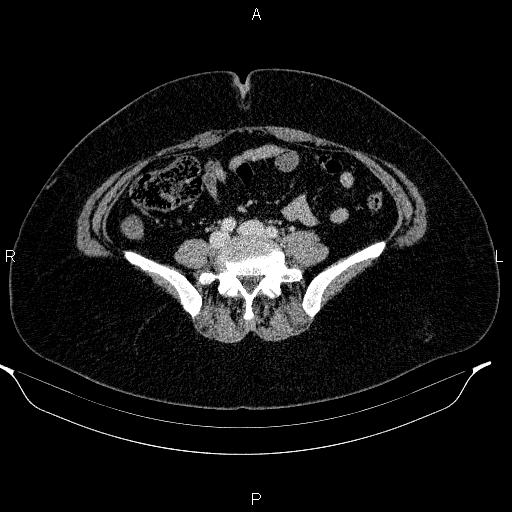 Appendiceal mucocele (Radiopaedia 83280-97688 Axial With contrast 70).jpg