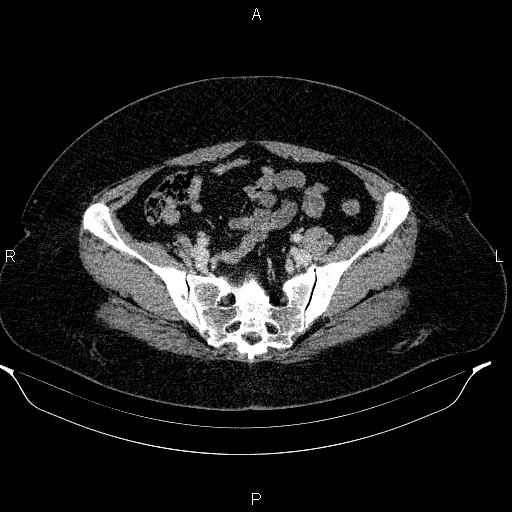 Appendiceal mucocele (Radiopaedia 83280-97688 Axial With contrast 82).jpg