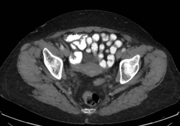 File:Appendicitis due to chicken fibula (Radiopaedia 74314-85198 A 47).jpg