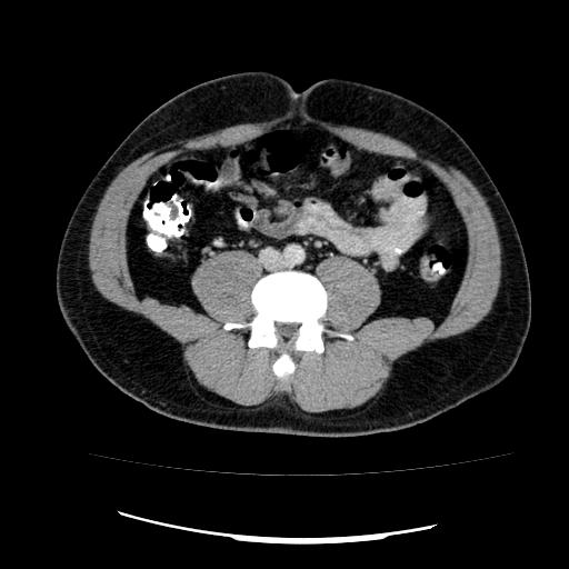 File:Appendicitis with diverticulosis (Radiopaedia 47693-52383 Axial C+ 89).jpg