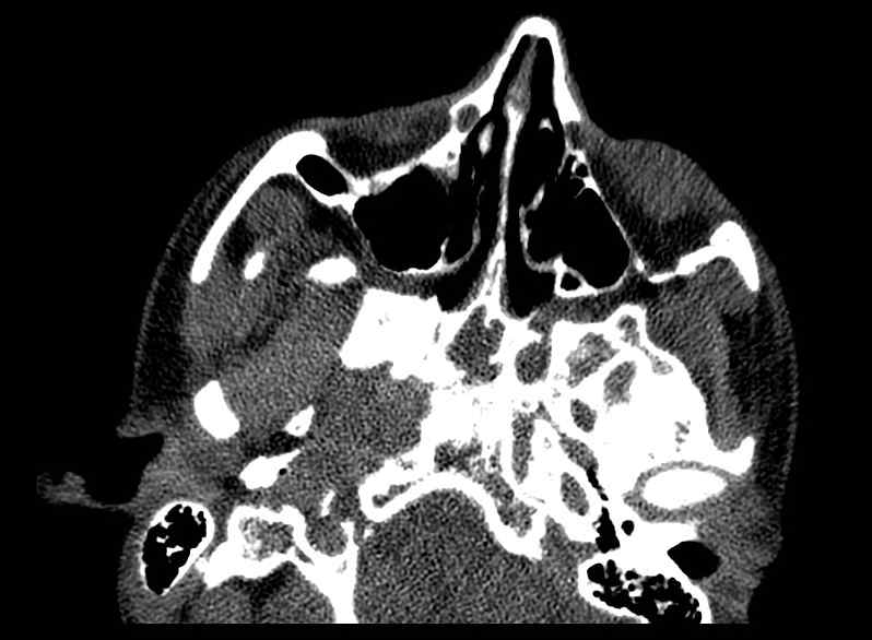 Arachnoid cyst- extremely large (Radiopaedia 68741-78450 Axial bone window 2).jpg