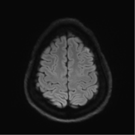 Arachnoid cyst - cerebellopontine angle (Radiopaedia 59689-67083 Axial DWI 66).png