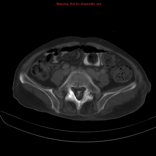 File:Arachnoiditis ossificans (Radiopaedia 51394-57136 Axial bone window 29).jpg