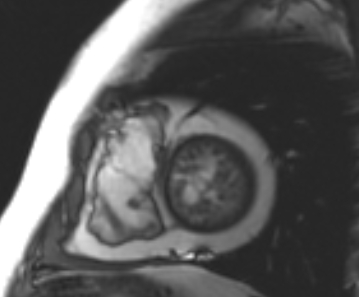 Arrhythmogenic right ventricular cardiomyopathy (Radiopaedia 69431-79307 Short axis cine 47).jpg