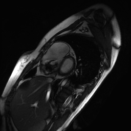 Arrhythmogenic right ventricular cardiomyopathy (Radiopaedia 87505-103850 short axis Cine SSFP 214).jpg
