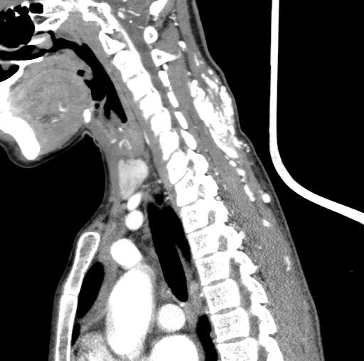 Arteriovenous malformation of the neck (Radiopaedia 53935-60062 C 58).jpg