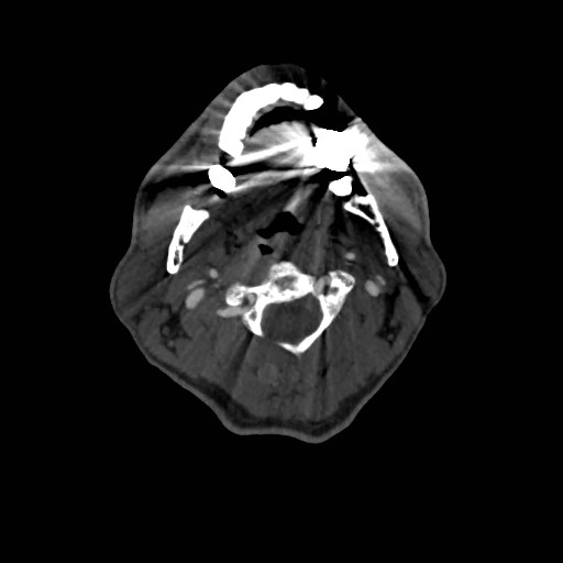 Artery of Percheron infarct (Radiopaedia 48088-52894 A 88).jpg