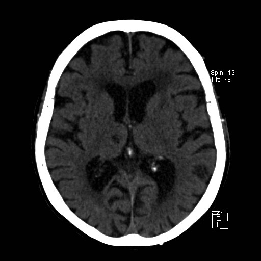 File:Artery of Percheron infarction (Radiopaedia 26307-26439 Axial non-contrast 22).jpg