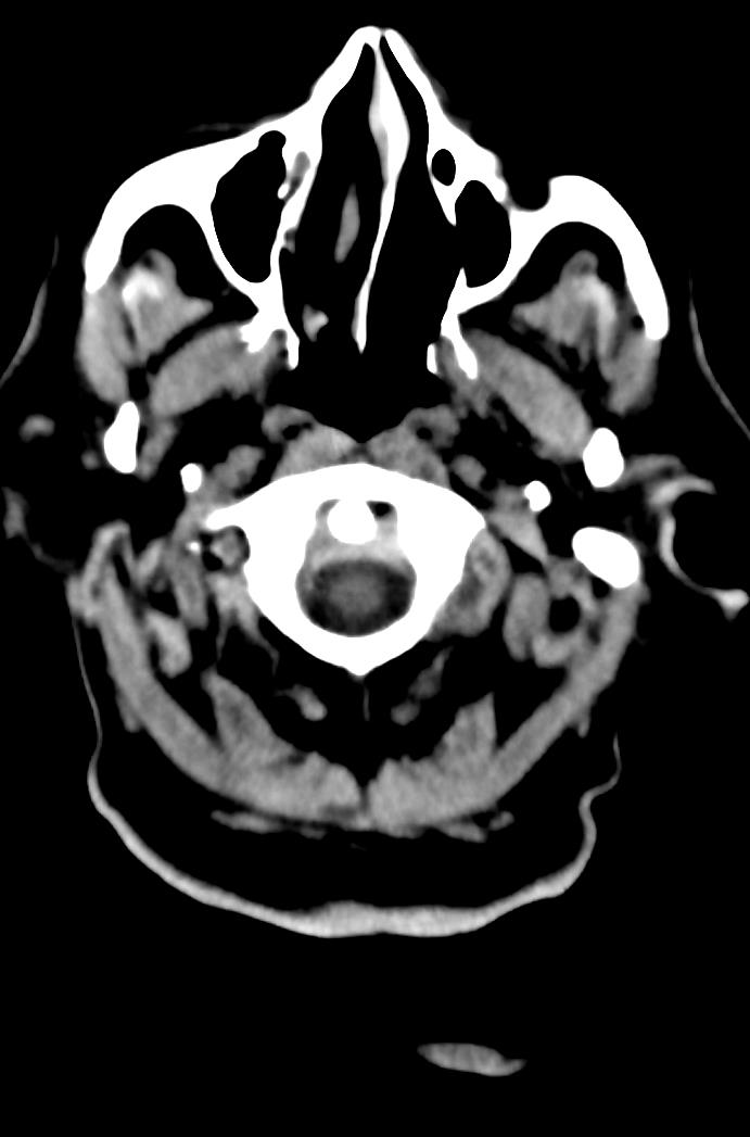 Artery of Percheron infarction (Radiopaedia 80613-94202 Axial non-contrast 15).jpg