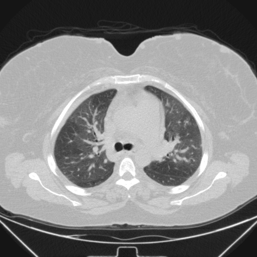 Aspergilloma (Radiopaedia 39611-41932 Axial lung window 44).jpg