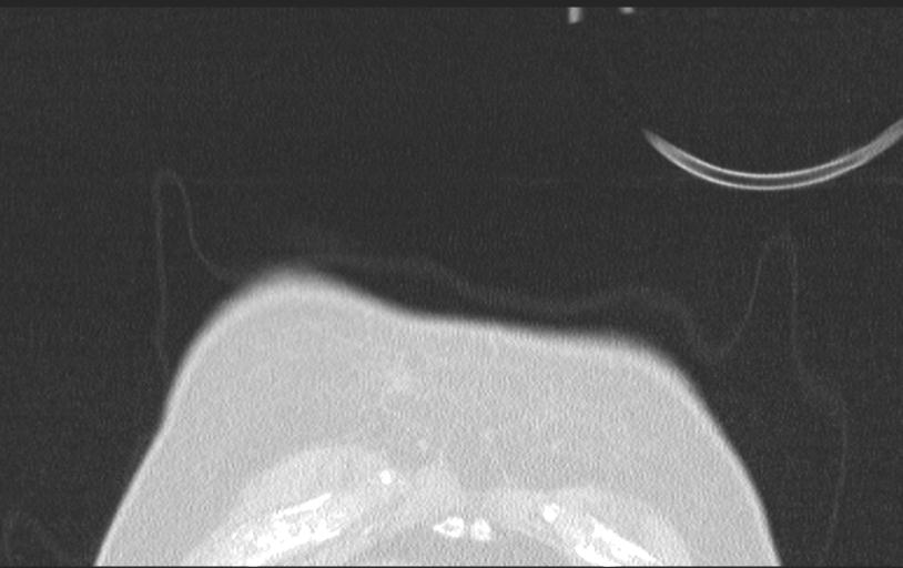 Aspirated tooth (Radiopaedia 28584-28844 Axial lung window 15).jpg