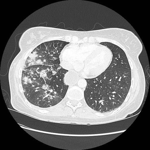 Aspiration pneumonia secondary to laparoscopic banding (Radiopaedia 18345-18183 lung window 79).jpg